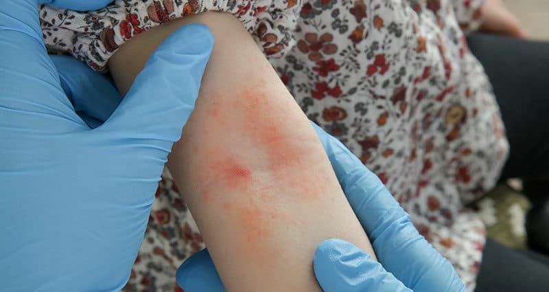 Doctor looking at red and itchy rash.